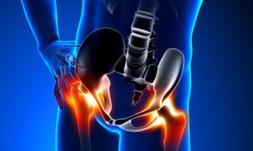 Zwyrodnienie stawu biodrowego – bolesna choroba, która długo pozostaje w ukryciu
