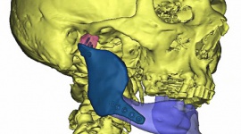 Indywidualny implant wydrukowany w drukarce 3D