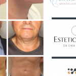 Lifting nieinwazyjny Endolift – co na jego temat mówią lekarze?