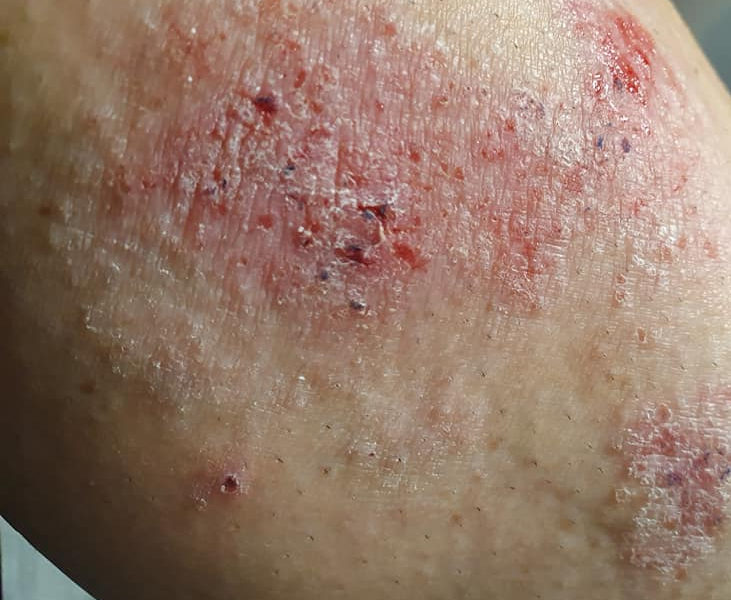 Minister-Zdrowi-AZS Pacjenci z ciężką postacią AZS apelują do Ministra Zdrowia o dostęp do terapii, która jest ich ostatnią deską ratunku.