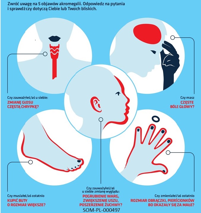 Akromegalia objawy Akromegalia – choroba widoczna gołym okiem, często jednak niedostrzegana – sukcesywnie powiększają się dłonie i stopy, a rysy twarzy zaostrzają się!
